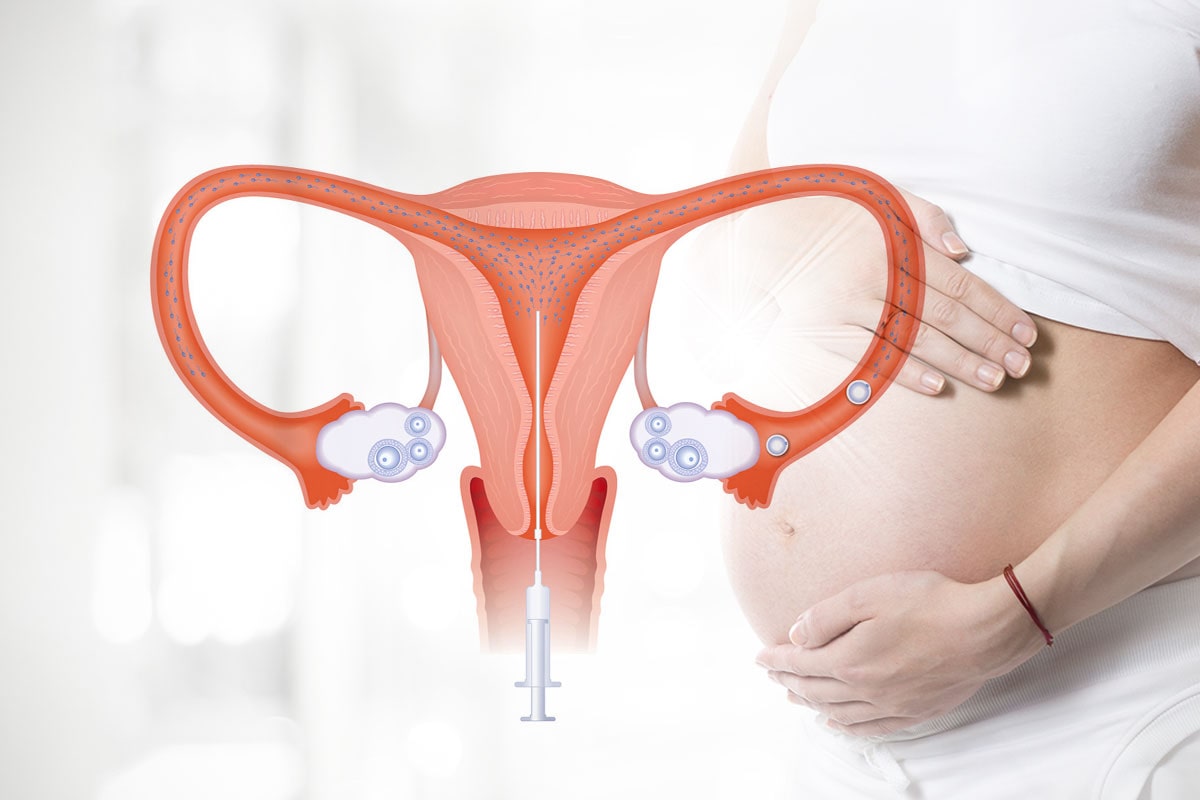 A concept photo showing Intrauterine Insemination (IUI) treatment