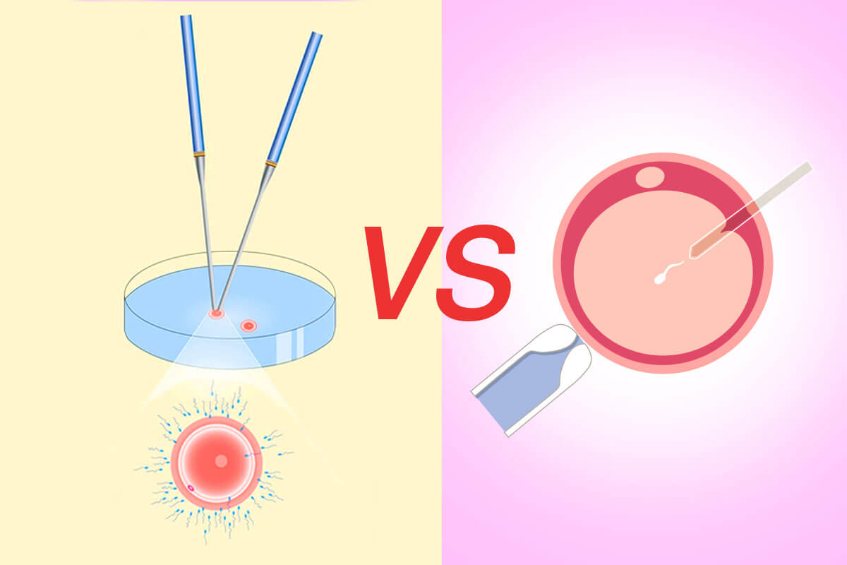 IVF vs. ICSI