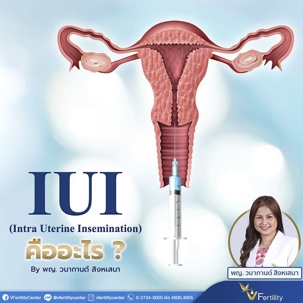 IUI