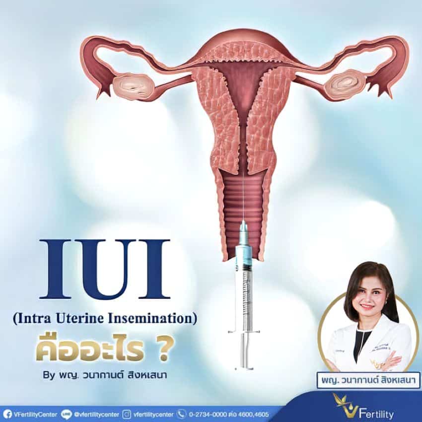 การทำ IUI ให้สำเร็จ