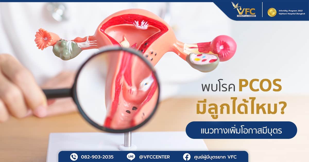 โรค PCOS คือ ความผิดปกติของระบบฮอร์โมนที่ทำให้ผู้ป่วยมีถุงน้ำในรังไข่หลายใบ