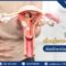 เยื่อบุโพรงมดลูกอักเสบ (Endometritis) คือภาวะที่มักเกิดจากการติดเชื้อในช่องคลอด