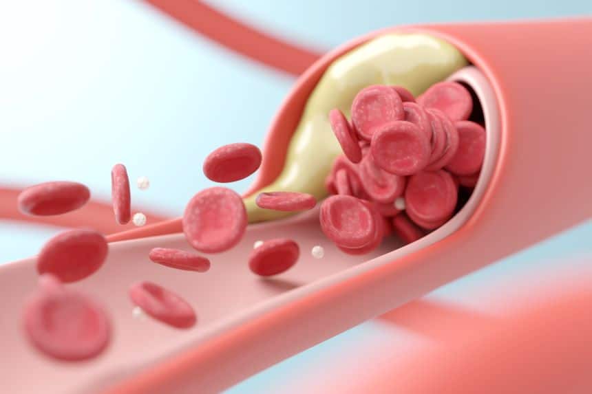 Blood vessel model showing high blood lipid condition