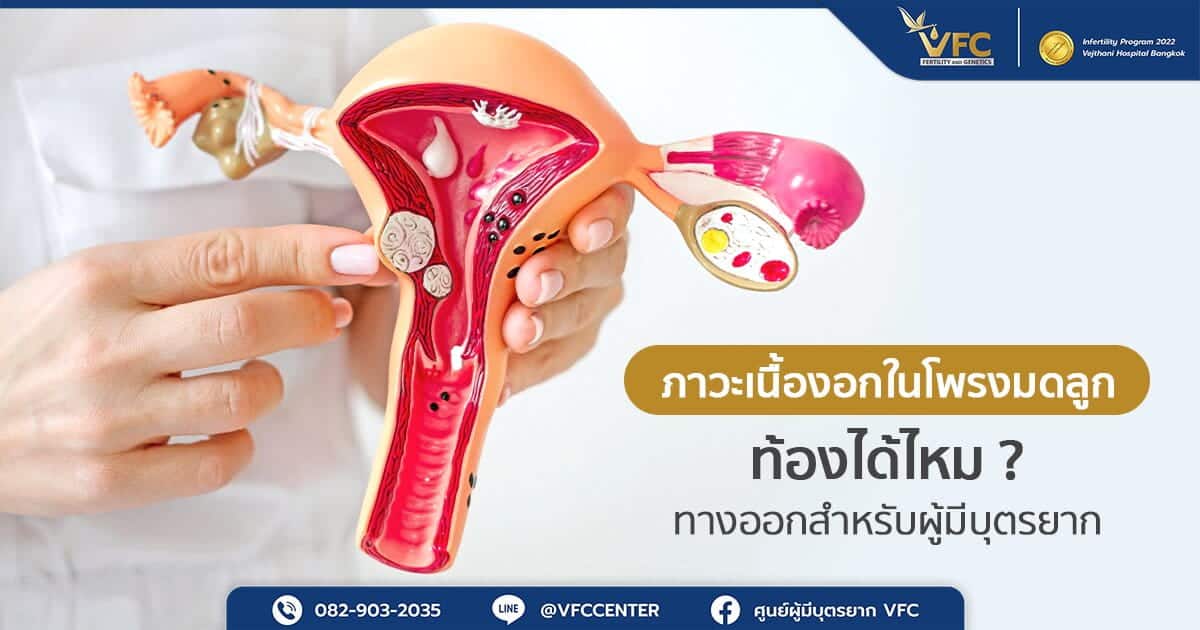 แนวทางการเตรียมมดลูกให้พร้อมเพื่อความสำเร็จในการทำ ICSI สำหรับผู้ที่มีเนื้องอกในโพรงมดลูก