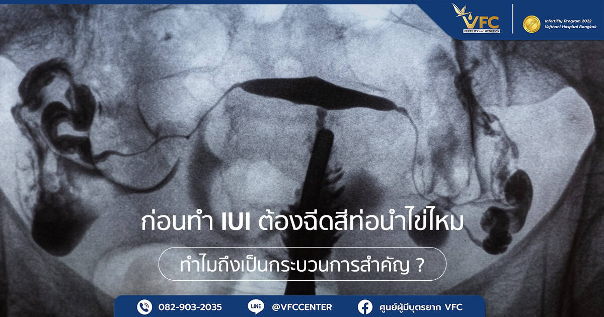 ภาพเอกซเรย์แสดงผลการฉีดสีท่อนำไข่